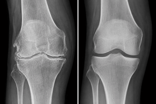 X-ray showing joint regeneration